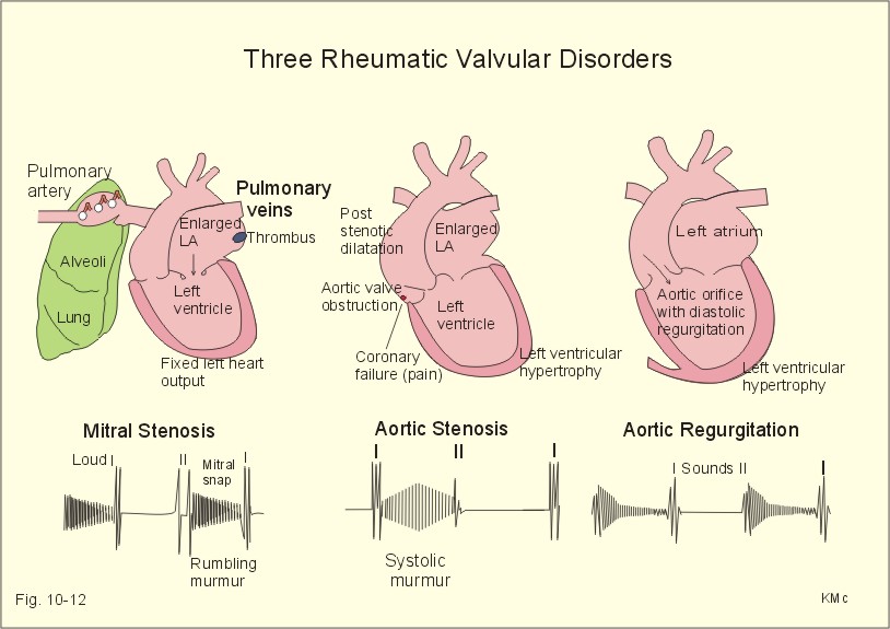 russell-s-blog-aortic-stenosis-murmur-location