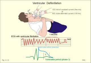 Ventricular defibrillation