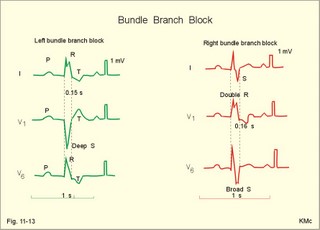 Right and left bundle branch block