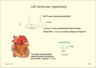left ventricular hypertrophy