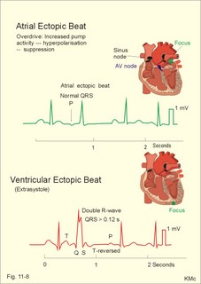Atrial and ventricular ectopic beats